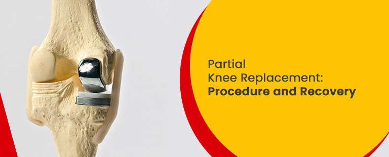 Partial knee Replacement Surgery